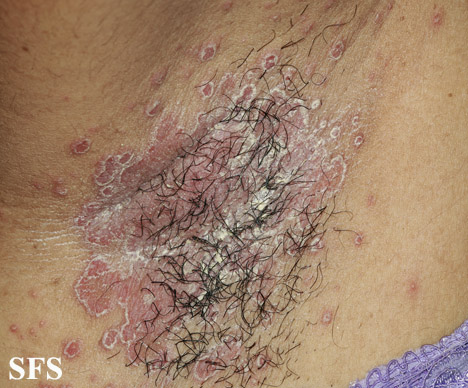 File:Candidiasis (Dermatology Atlas 38).jpg
