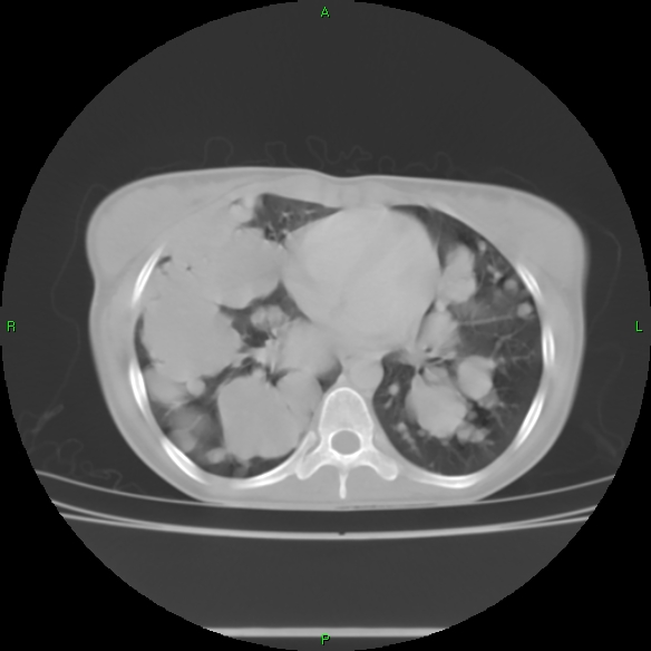 File:Cannon ball metastases - synovial sarcoma (Radiopaedia 26135-26271 Axial lung window 22).jpg