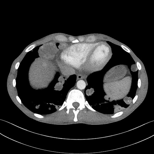 Cannonball metastases - testicular choriocarcinoma (Radiopaedia 84510-99891 B 87).jpg