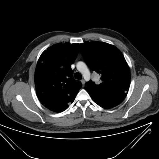 File:Cannonball pulmonary metastases (Radiopaedia 67684-77101 D 92).jpg