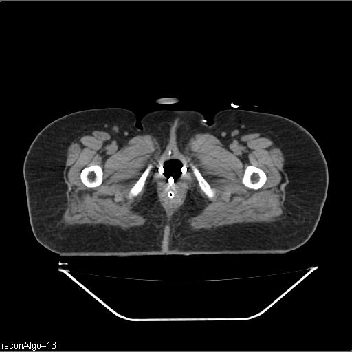 Carcinoma cervix- brachytherapy applicator (Radiopaedia 33135-34173 Axial non-contrast 52).jpg