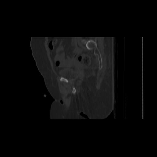 Carcinoma cervix- brachytherapy applicator (Radiopaedia 33135-34173 Sagittal bone window 61).jpg