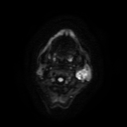 Carcinoma ex-pleomorphic adenoma of parotid (Radiopaedia 28383-28627 Ax DWI B-500 GE 51).jpg
