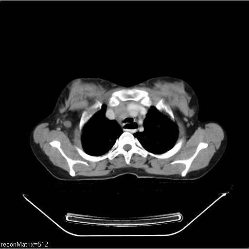 File:Carcinoma of esophagus (Radiopaedia 27356-27550 A 27).jpg