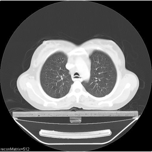 File:Carcinoma of esophagus (Radiopaedia 27356-27550 Axial lung window 24).jpg
