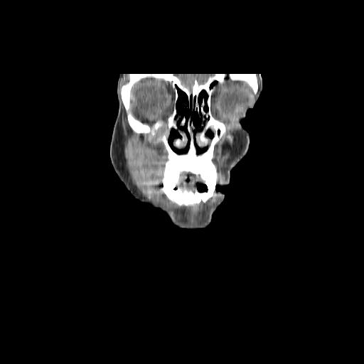 Carcinoma of the maxillary antrum (Radiopaedia 53805-59888 Coronal C+ delayed 19).jpg