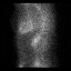 Cardiac amyloidosis (Radiopaedia 51404-57239 A 57).jpg