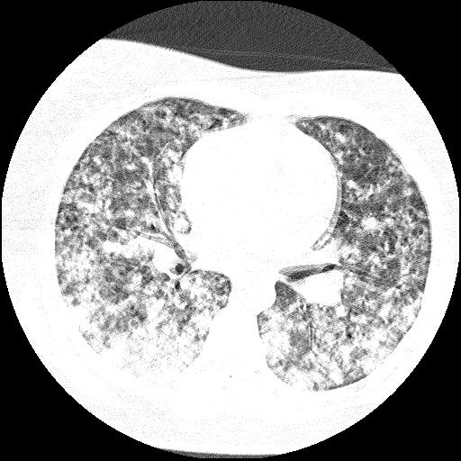 Cardiac angiosarcoma (Radiopaedia 66010-75181 Axial lung window 48).jpg