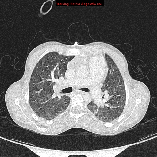 File:Cardiac bronchus (Radiopaedia 14059-13899 A 11).jpg