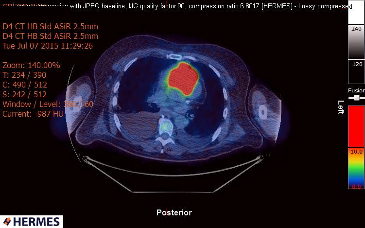 File:Cardiac lymphoma (Radiopaedia 38690-40871 Integrated PET-CT 10).jpg