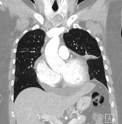File:Cardiac sarcoidosis (Radiopaedia 74548-85534 Coronal lung window 23).jpg