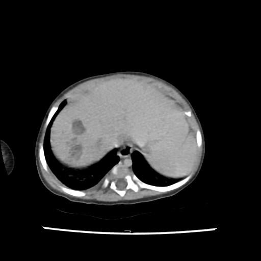 File:Caroli disease with autosomal recessive polycystic kidney disease (ARPKD) (Radiopaedia 89651-106703 B 23).jpg