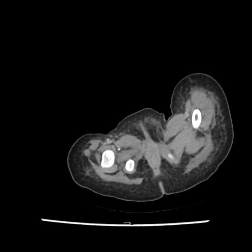 File:Caroli disease with autosomal recessive polycystic kidney disease (ARPKD) (Radiopaedia 89651-106703 B 244).jpg