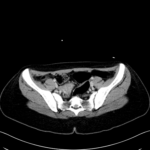 Caroli disease with medullary sponge kidney (Radiopaedia 82622-96804 C 60).jpg