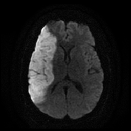 File:Carotid arterial dissection with acute cerebral infarction (Radiopaedia 26636-26784 Axial DWI 12).jpg