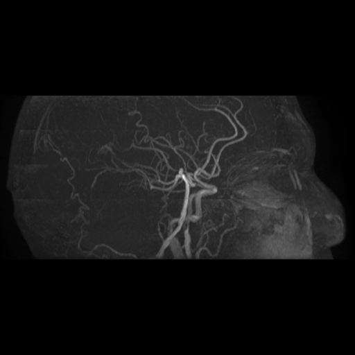 Carotid arterial dissection with acute cerebral infarction (Radiopaedia 26636-26784 MRA 19).jpg