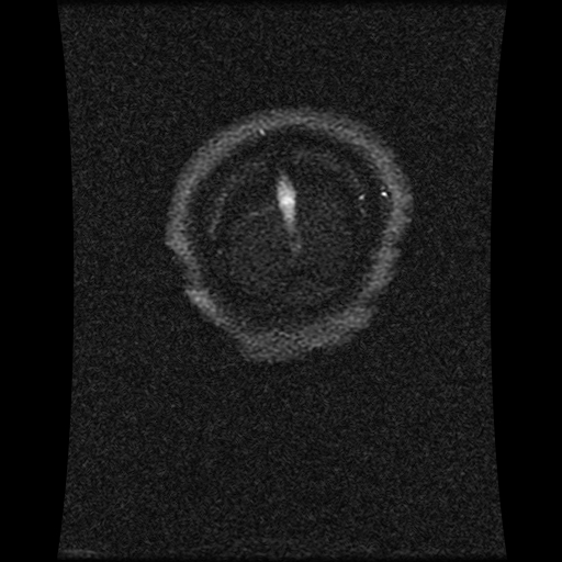Carotid arterial dissection with acute cerebral infarction (Radiopaedia 26636-26784 MRV 32).jpg