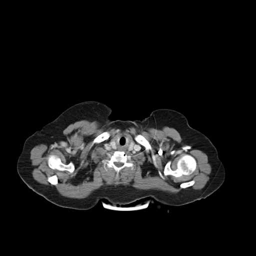 File:Carotid body tumor (Radiopaedia 21021-20948 B 21).jpg