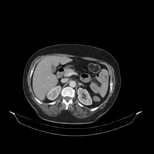 File:Carotid body tumor (Radiopaedia 21021-20948 B 68).jpg