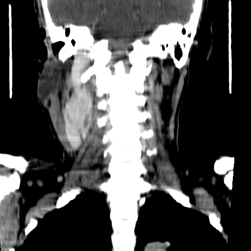 File:Carotid body tumor (Radiopaedia 27890-28124 B 5).jpg