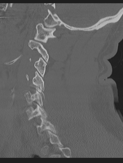Cavernoma of cervical cord (Radiopaedia 50838-56346 Sagittal bone window 55).png