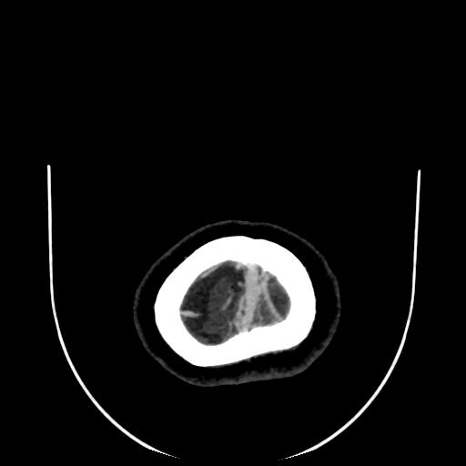 Cavernoma with developmental venous anomaly (Radiopaedia 22470-22506 C 198).jpg