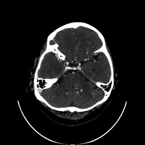 Cavernoma with developmental venous anomaly (Radiopaedia 22470-22506 C 38).jpg