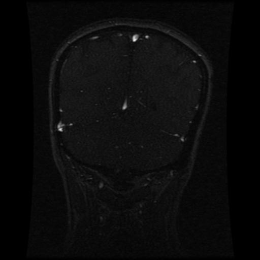 Cavernoma with developmental venous anomaly (Radiopaedia 22470-22507 MRV 46).jpg