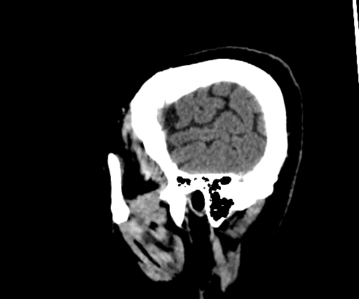 Cavernous hemangioma of the cerebellar falx (Radiopaedia 73025-83723 B 44).jpg