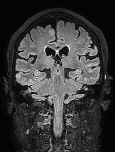 Cavernous hemangioma of the cerebellar falx (Radiopaedia 73025-83724 Coronal FLAIR 210).jpg