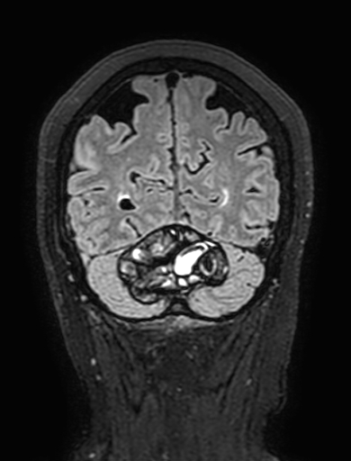 Cavernous hemangioma of the cerebellar falx (Radiopaedia 73025-83724 Coronal FLAIR 288).jpg