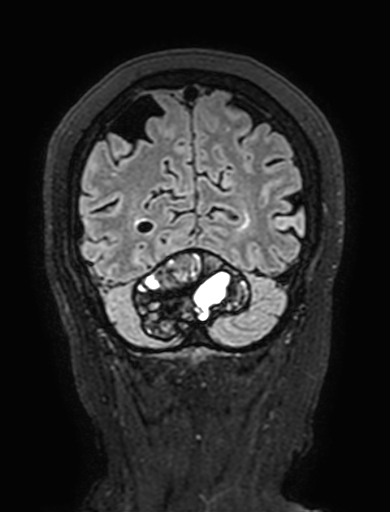 Cavernous hemangioma of the cerebellar falx (Radiopaedia 73025-83724 Coronal FLAIR 296).jpg