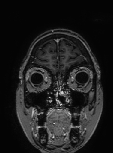 Cavernous hemangioma of the cerebellar falx (Radiopaedia 73025-83724 Coronal T1 C+ 55).jpg