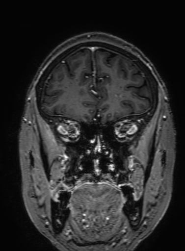 Cavernous hemangioma of the cerebellar falx (Radiopaedia 73025-83724 Coronal T1 C+ 94).jpg