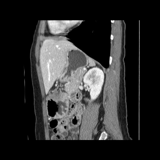 Cavernous hepatic hemangioma (Radiopaedia 75441-86667 D 133).jpg