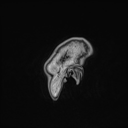 Cavernous sinus meningioma (Radiopaedia 63682-72367 Sagittal T1 C+ 166).jpg