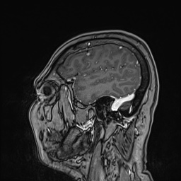 Cavernous sinus meningioma (Radiopaedia 63682-72367 Sagittal T1 C+ 45).jpg
