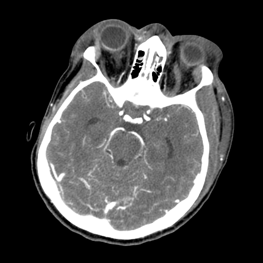 File:Cavernous sinus thrombosis (Radiopaedia 10619-11078 A 3).jpg