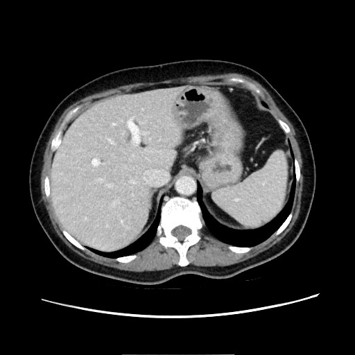 Cecal adenocarcinoma (Radiopaedia 75909-87331 A 24).jpg