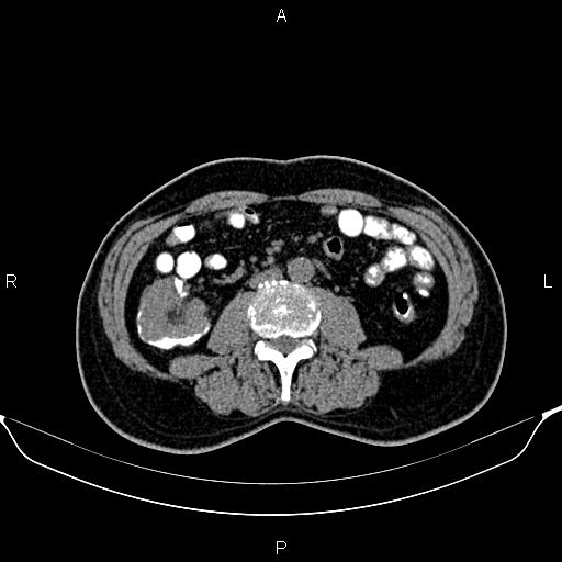 Cecal adenocarcinoma (Radiopaedia 85324-100916 Axial non-contrast 51).jpg
