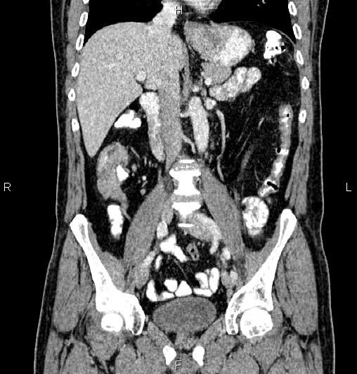 Cecal adenocarcinoma (Radiopaedia 85324-100916 D 32).jpg