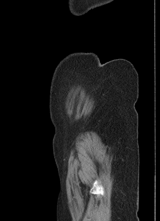 Cecal adenocarcinoma - surgical scar recurrence (Radiopaedia 79988-93264 D 64).jpg