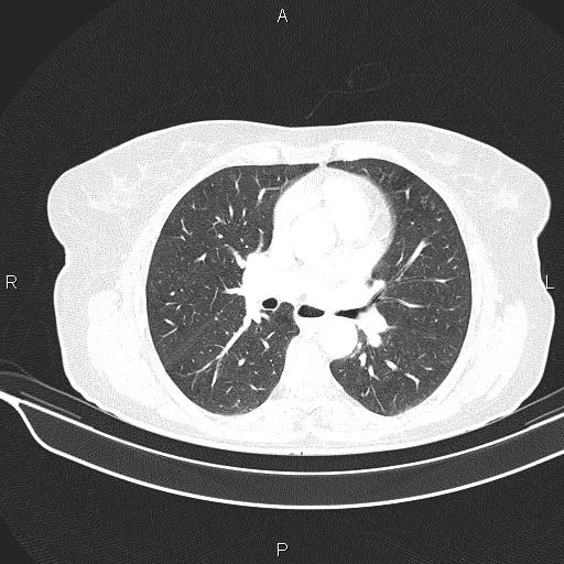 Cecal cancer (Radiopaedia 85610-101358 Axial lung window 32).jpg