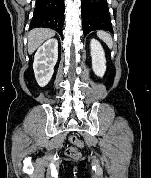 Cecal cancer with appendiceal mucocele (Radiopaedia 91080-108651 D 58).jpg