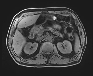 Cecal mass causing appendicitis (Radiopaedia 59207-66532 Axial T1 50).jpg