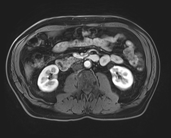 Cecal mass causing appendicitis (Radiopaedia 59207-66532 H 68).jpg