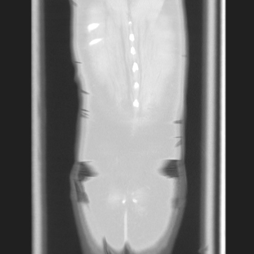 Cecal volvulus (Radiopaedia 75378-86620 Coronal lung window 126).jpg