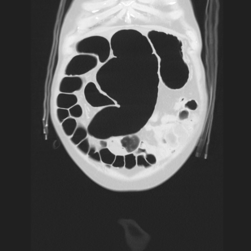 Cecal volvulus (Radiopaedia 75378-86620 Coronal lung window 33).jpg