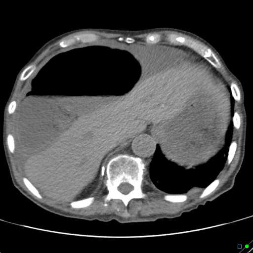 Cecal volvulus - atypical (Radiopaedia 21637-21588 non-contrast 12).jpg
