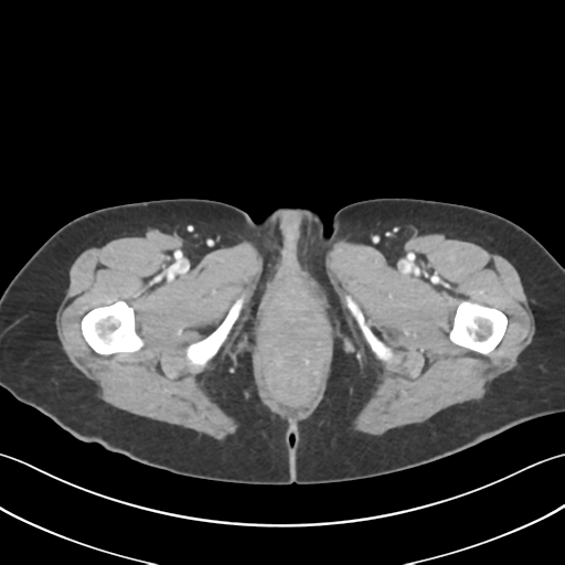 Cecum hernia through the foramen of Winslow (Radiopaedia 46634-51112 A 82).png